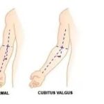 Cubitus Valgus(carrying angle)